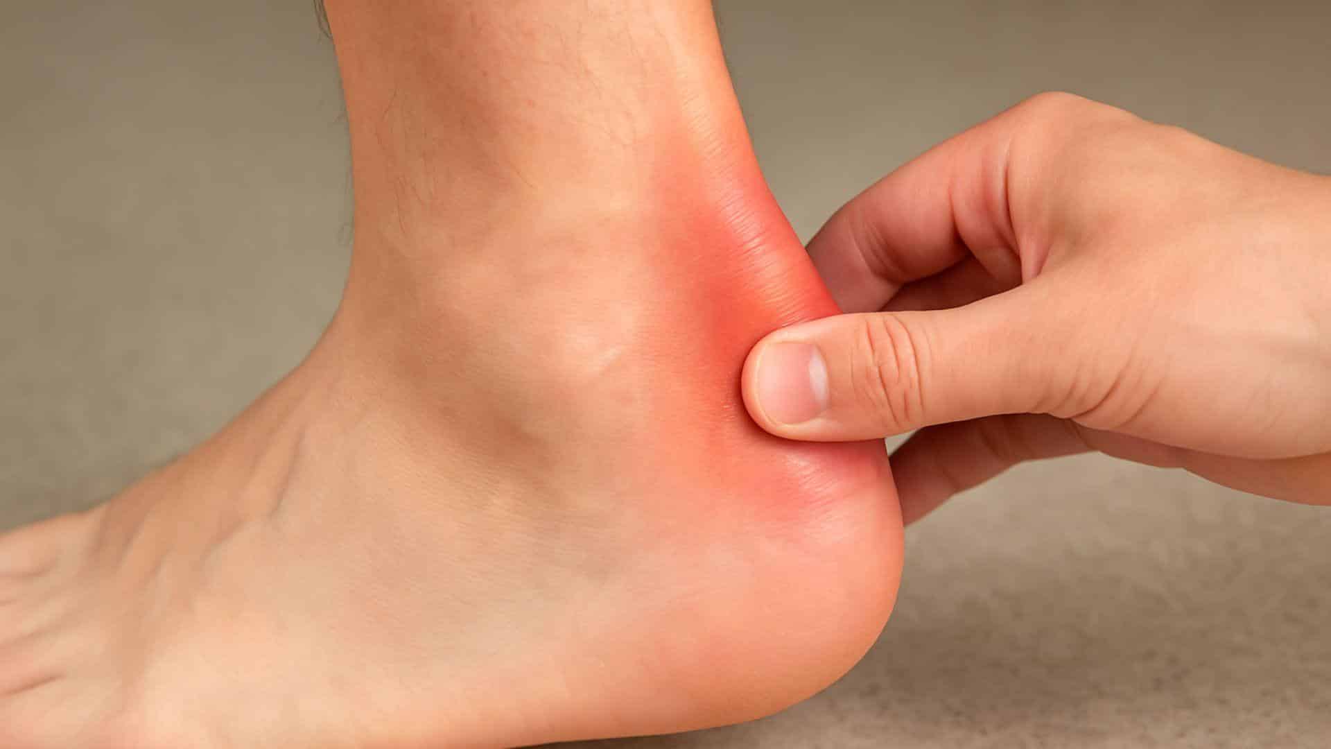 Achilles Tendonitis