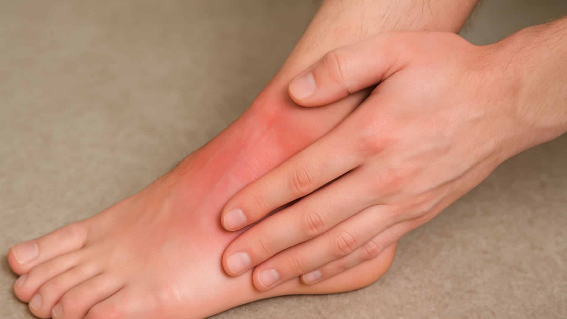 Ankle-Sprains