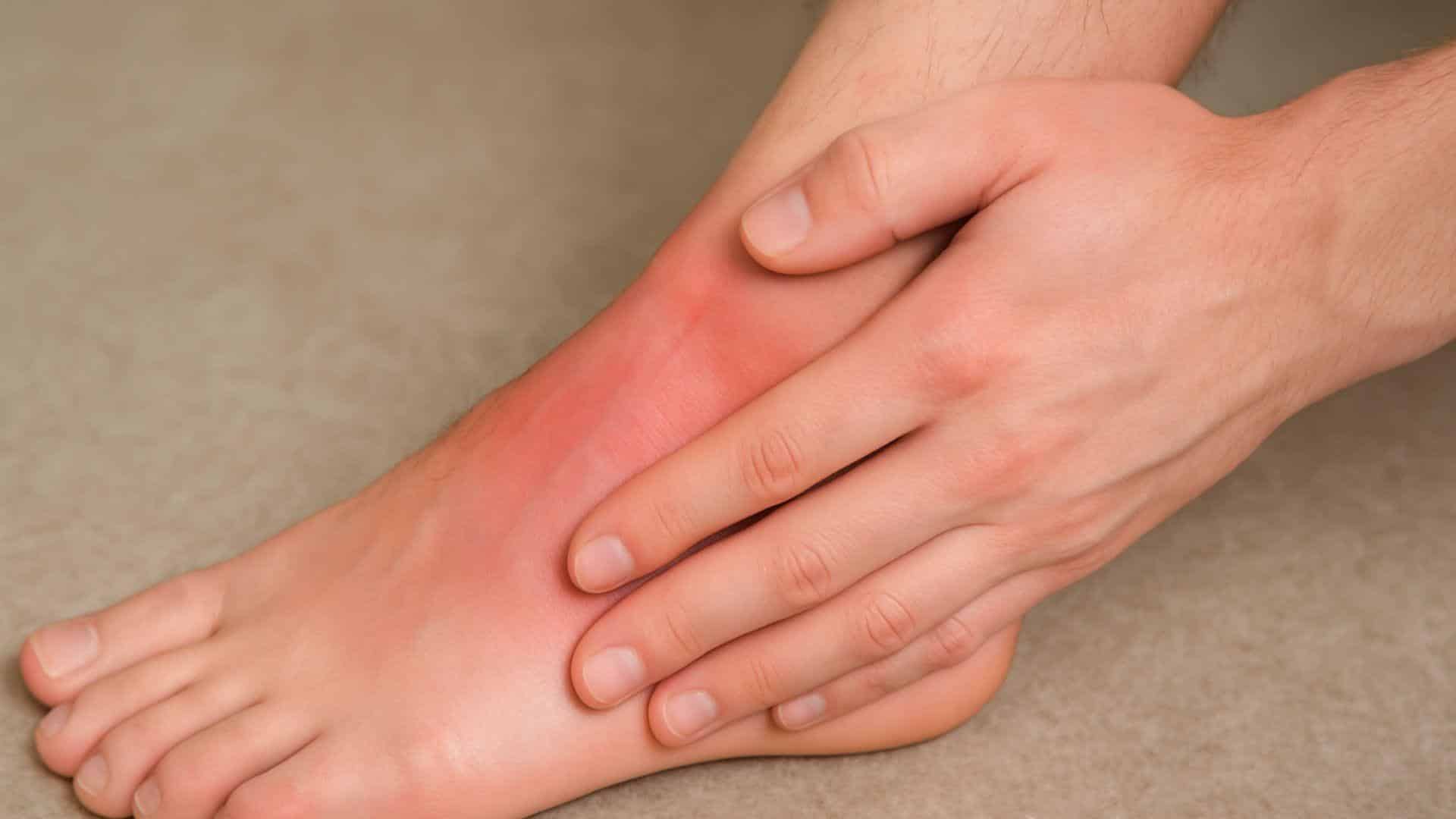 Ankle Sprains