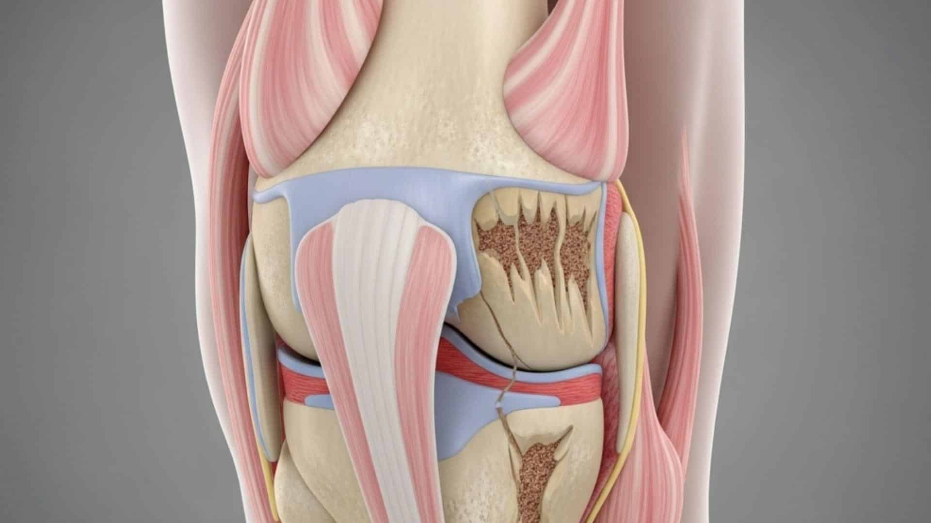 Arthritis (osteoarthritis)