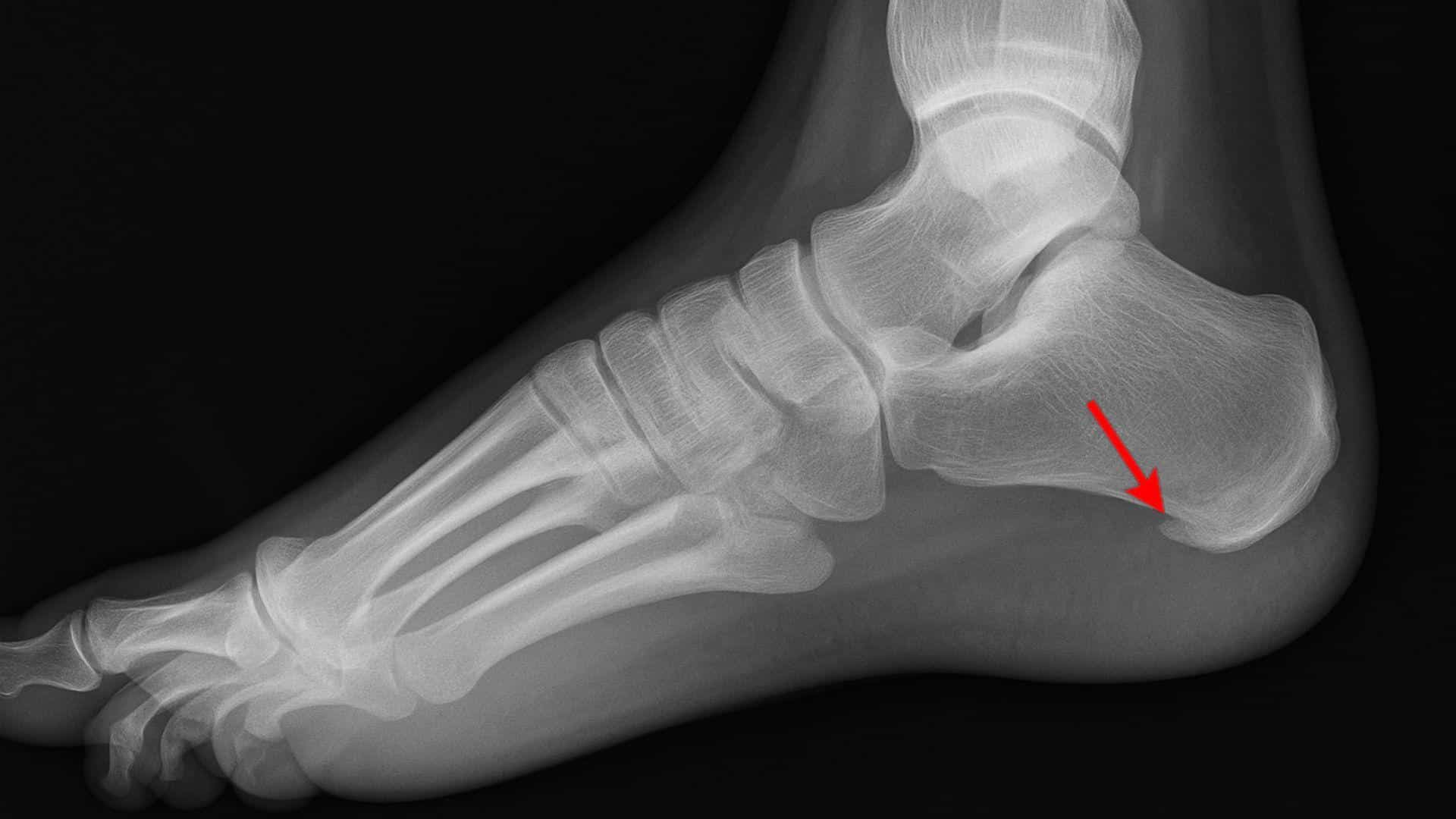 Bone Spurs