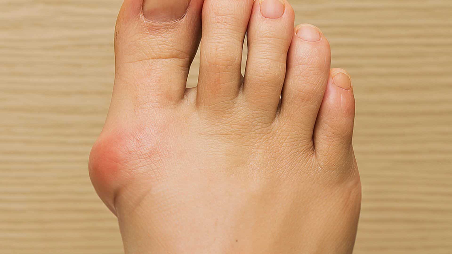Bunions