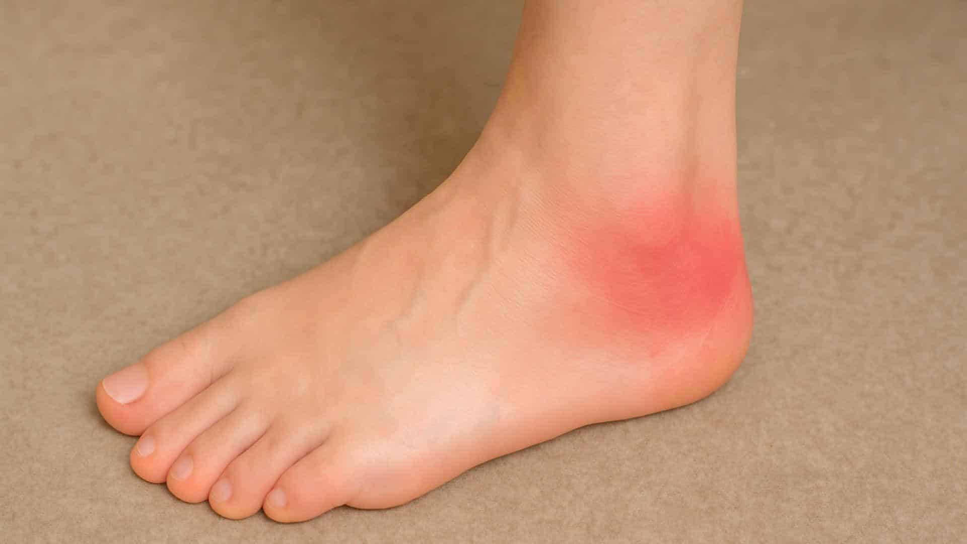 Bursitis