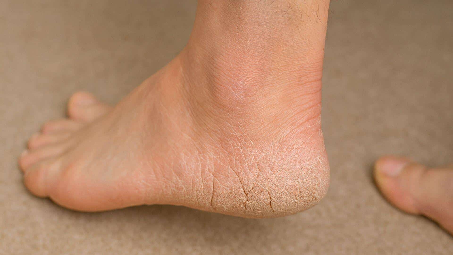 Cracked Heels