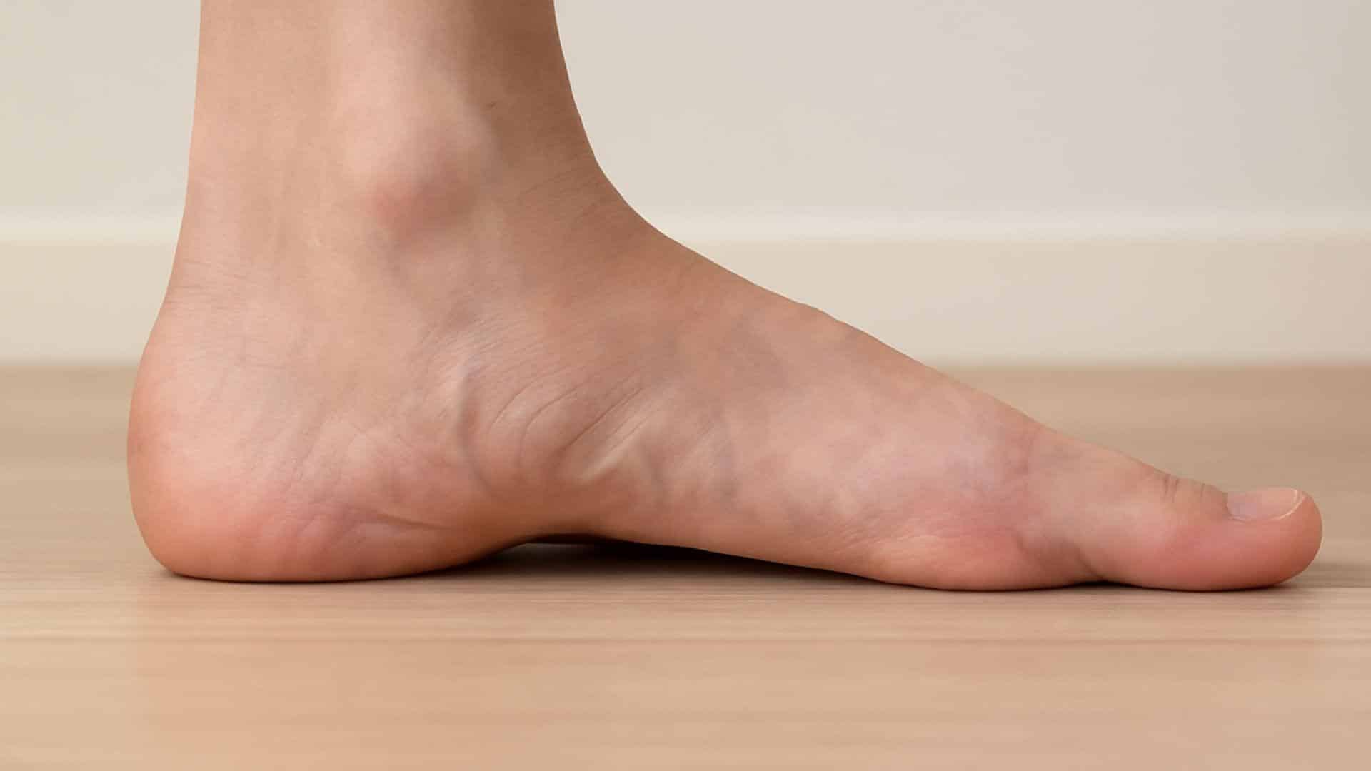 Flat Feet (fallen Arches)