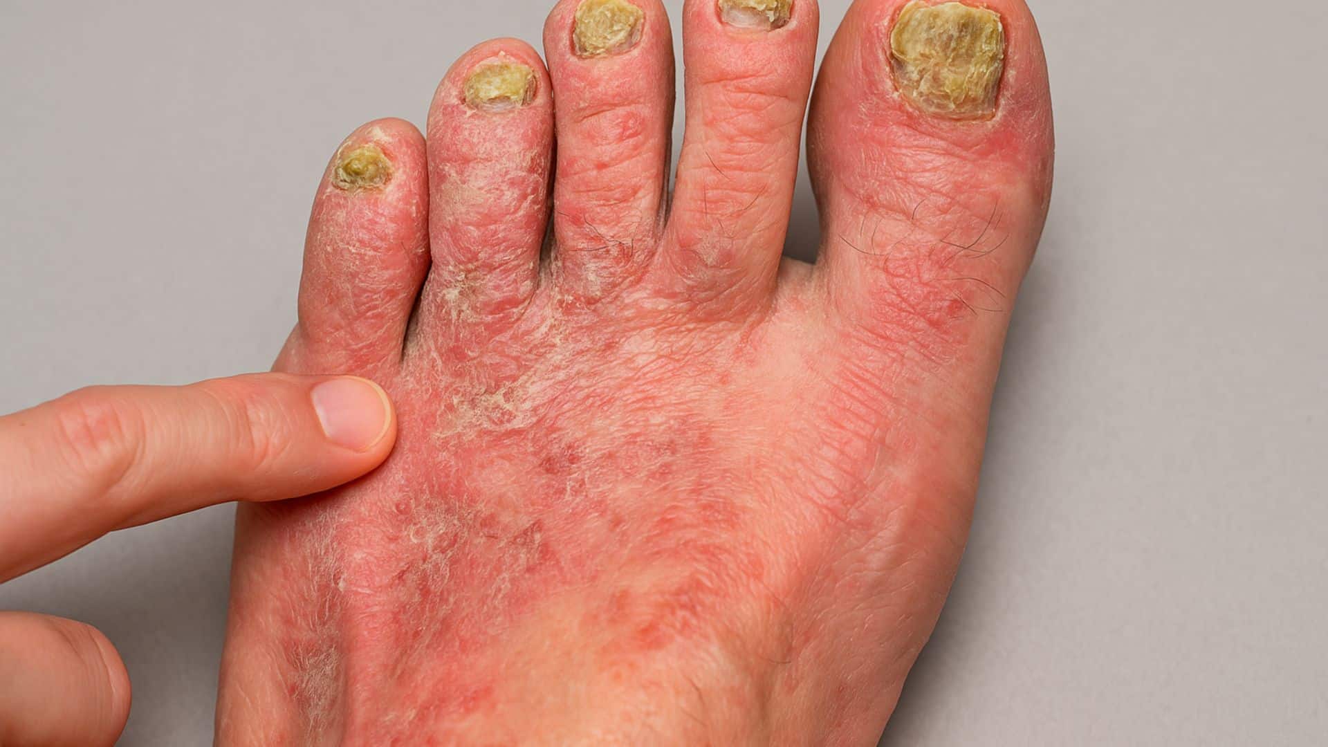 Fungal-Infections