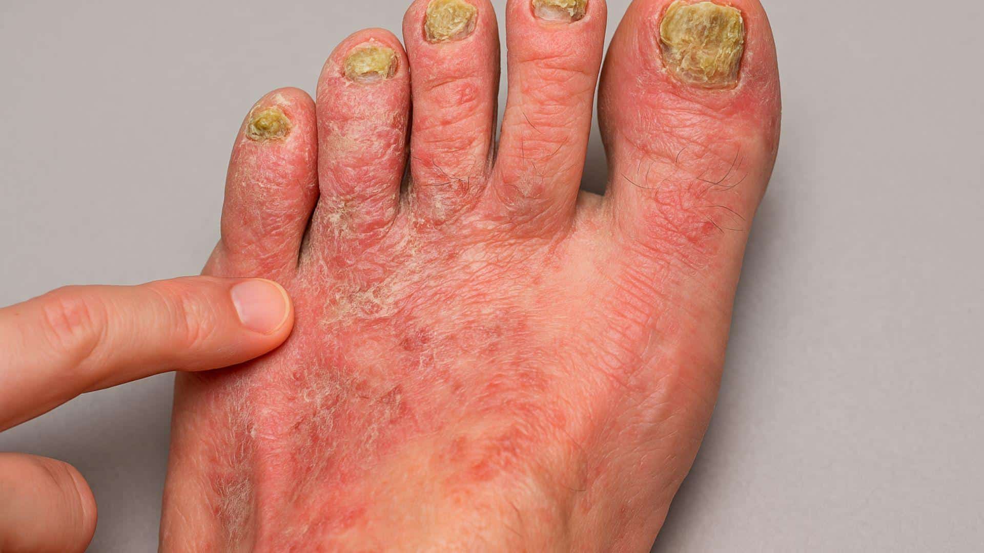 Fungal Infections