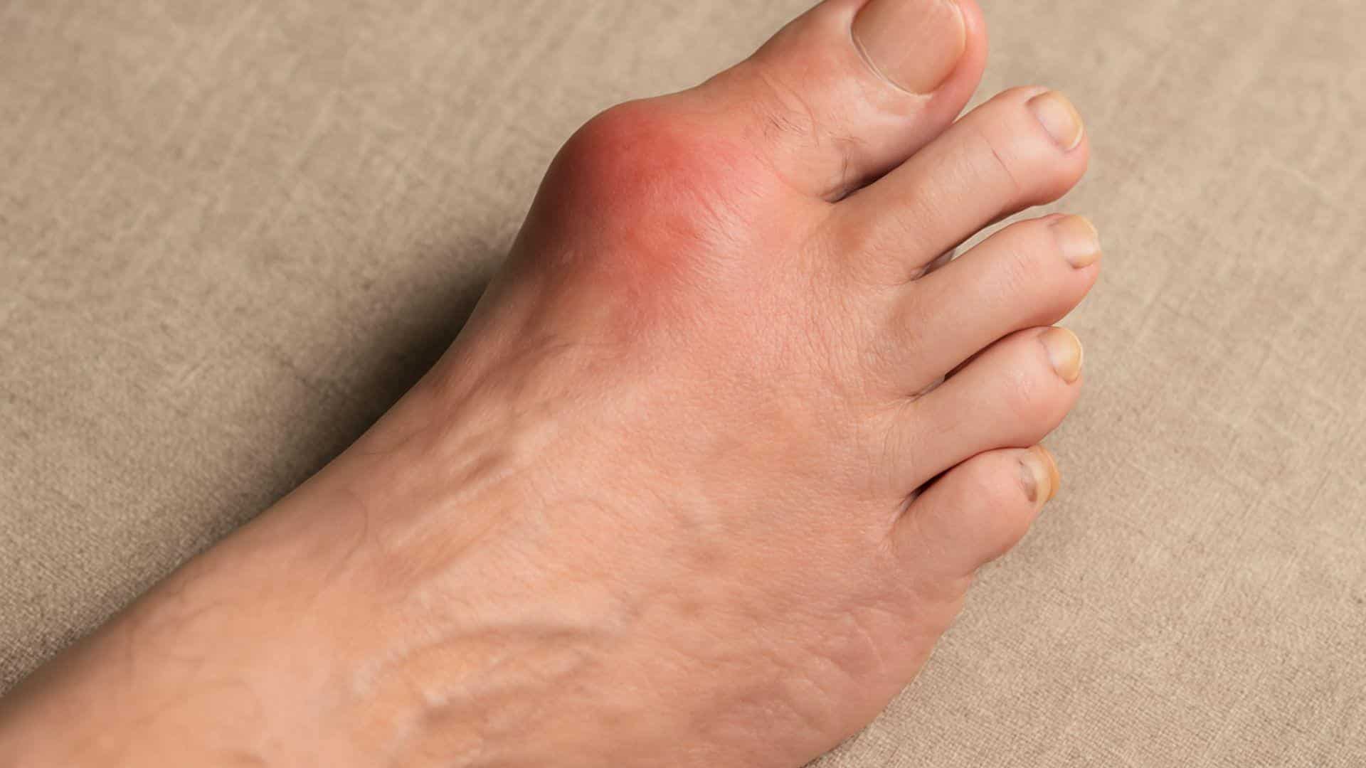 Gout