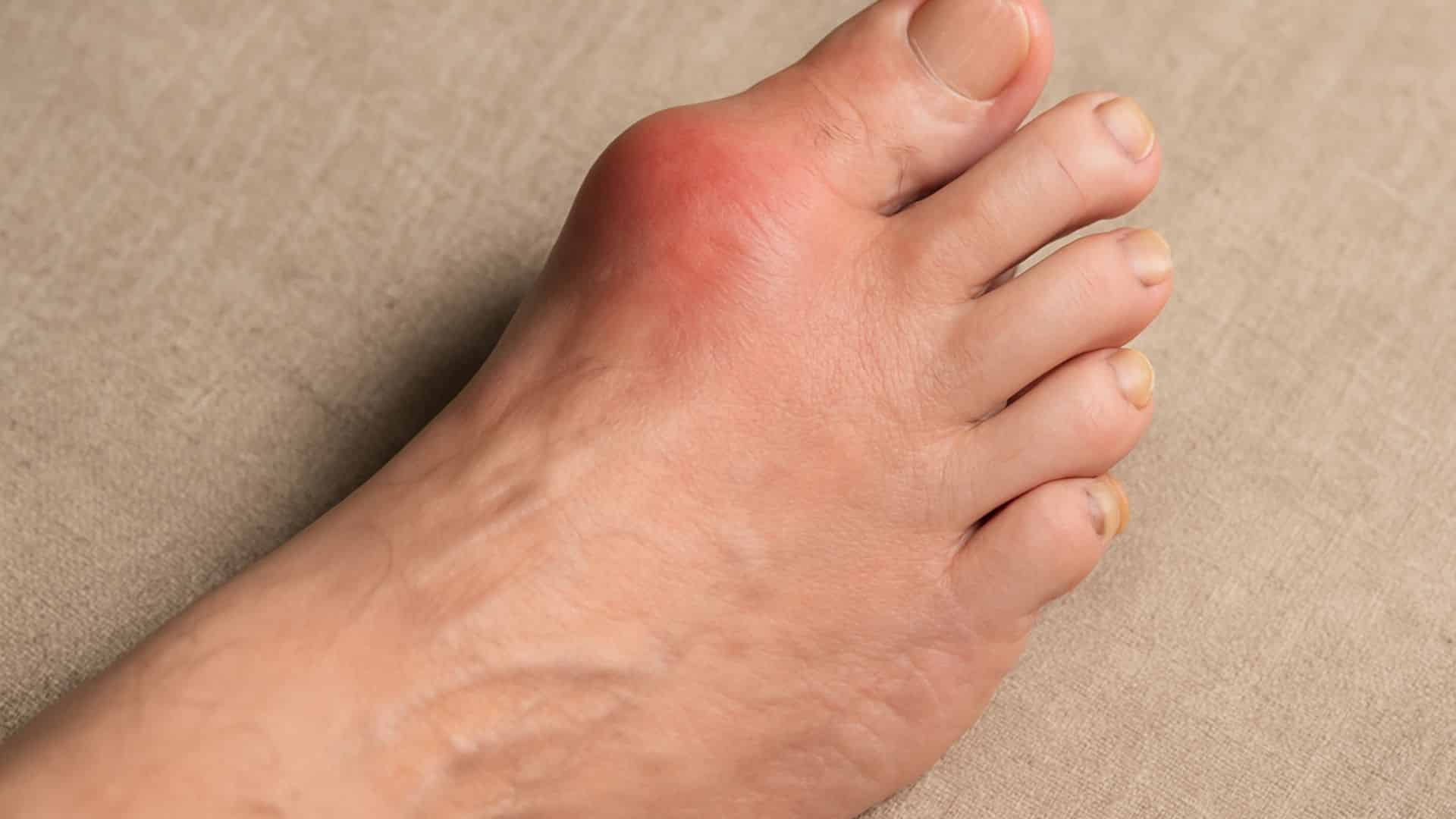 _Gout