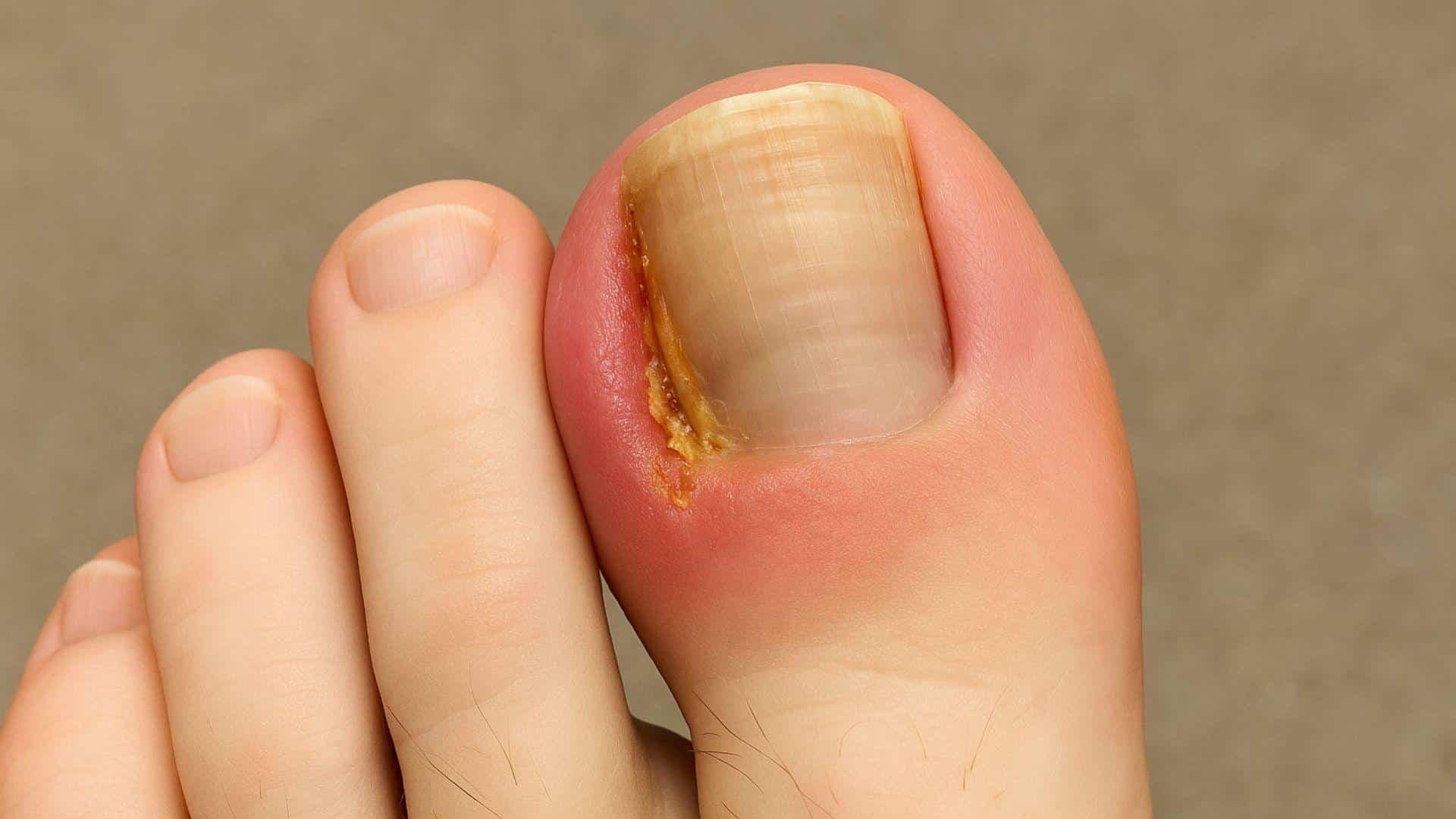 Ingrown Toenails
