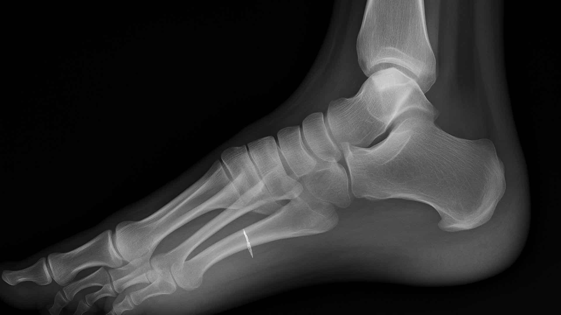 Stress Fractures