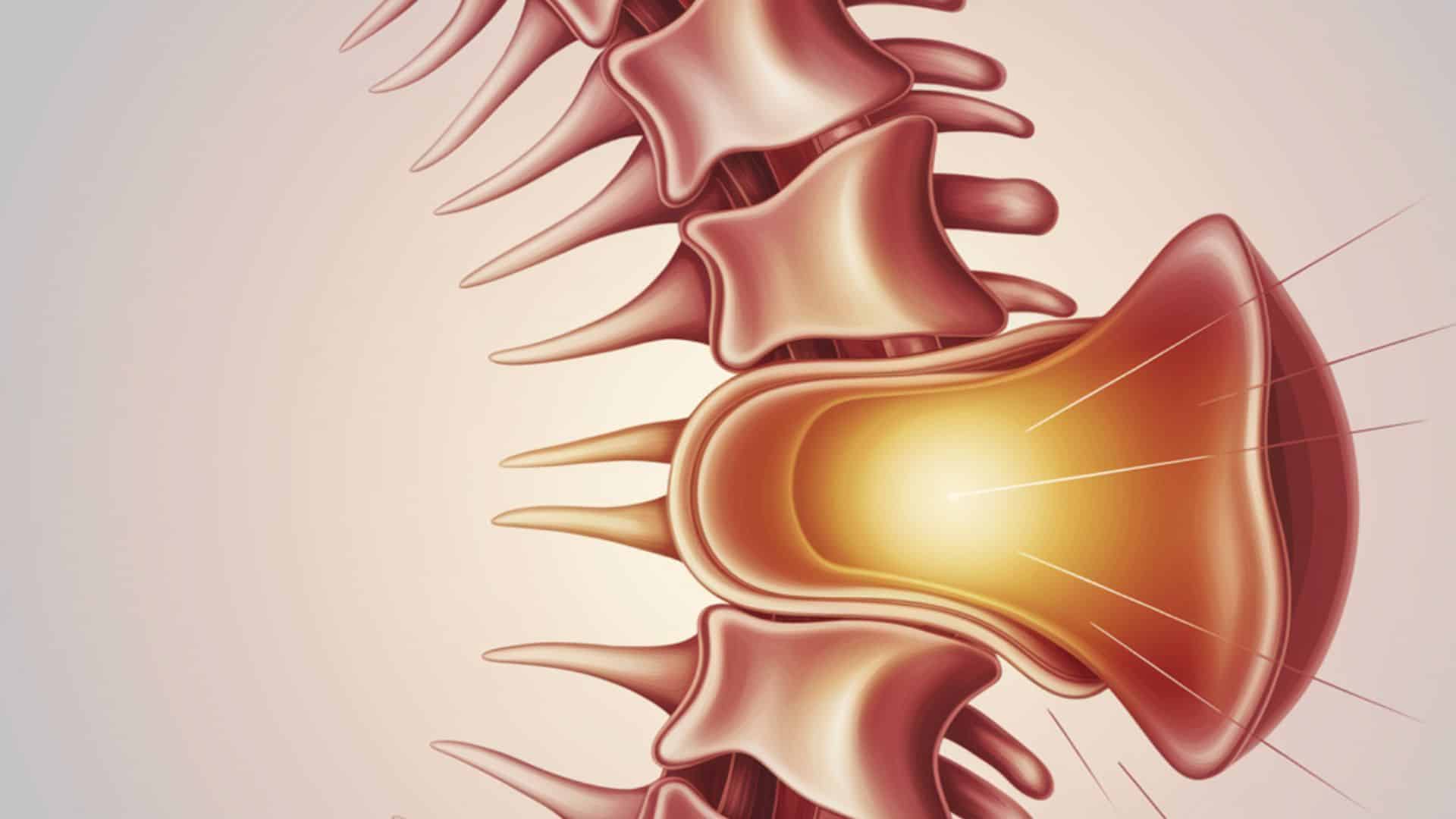 Thecal Sac Compression A Complete Patient Guide
