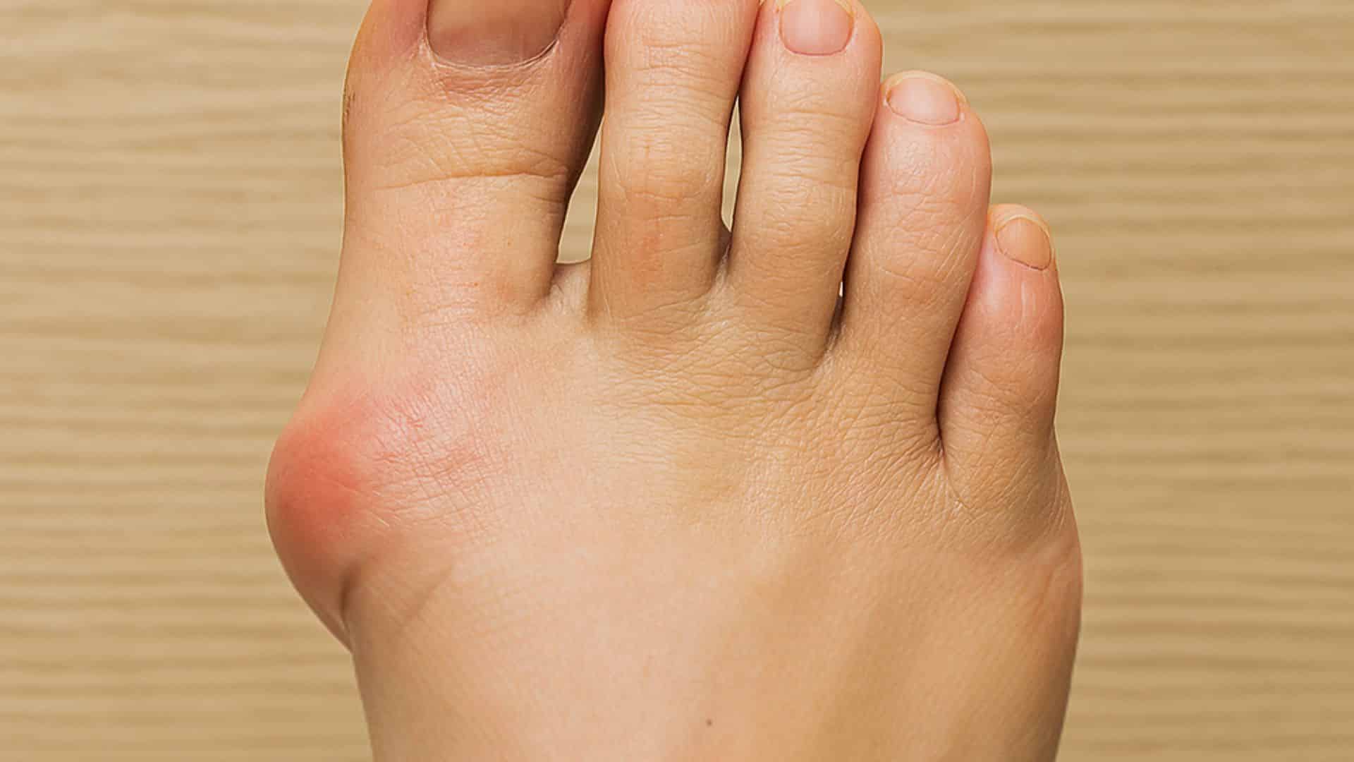 bunions-on-feet-pictures.png