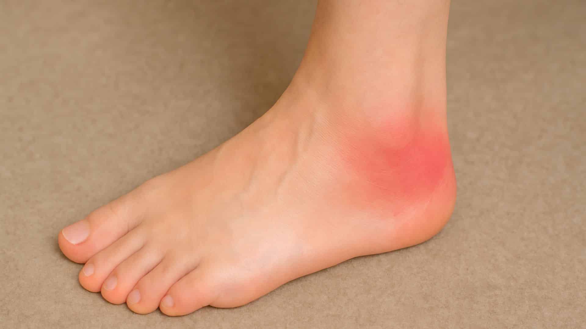 bursitis-foot