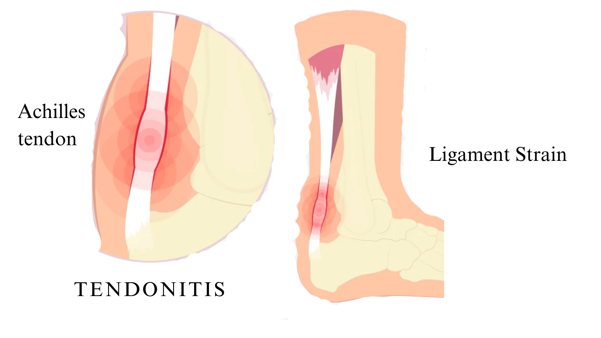 Tendonitis